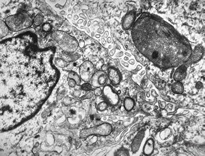M,1y. | plexus papilloma M,1y. | plexus papilloma